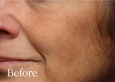 Before image: a woman with a mixed complexion